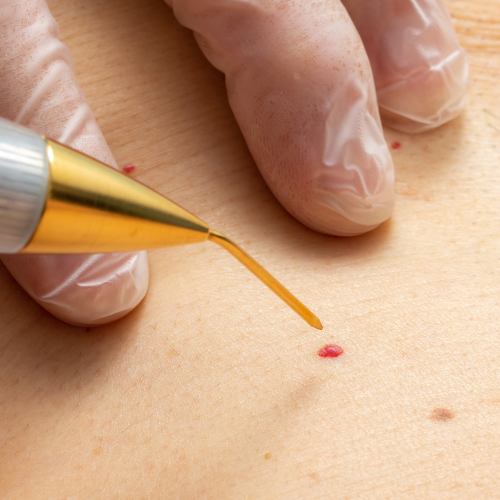 Retirada de verrugas, pintas, sinais, pólipos e cistos e lipomas